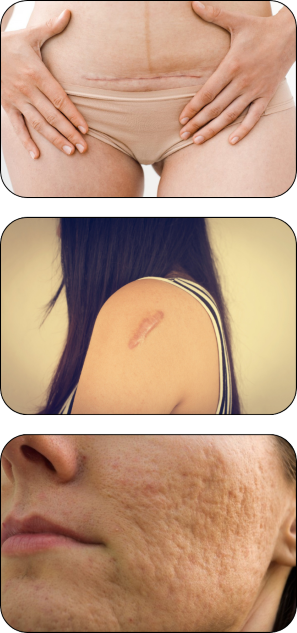 KDerma - Cicatrices - Beneficios_Opt