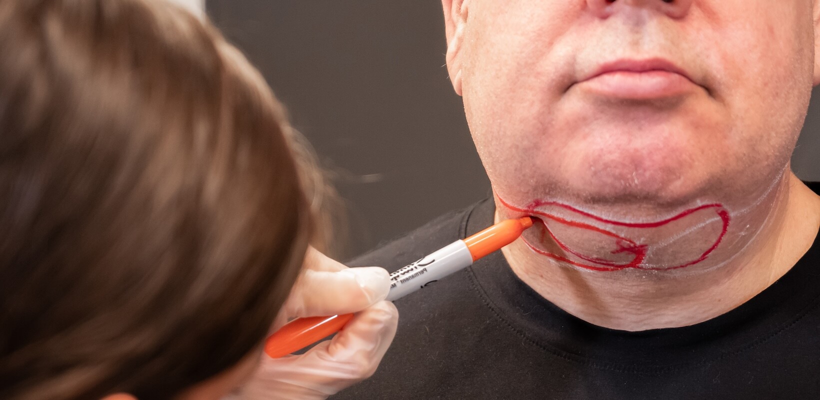 KDerma - Criolipólisis - Reductivo Papada Lipo 01